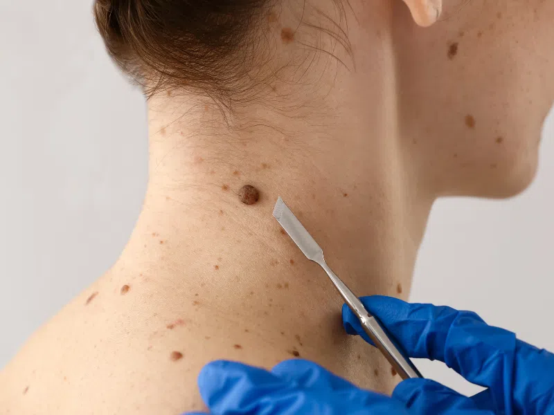 Skin cancer check consultation - skin cancer screening and excision Belconnen