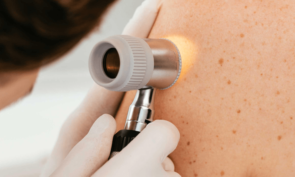 Complete Guide to Skin Cancer Checks in Belconnen (2026) 3
