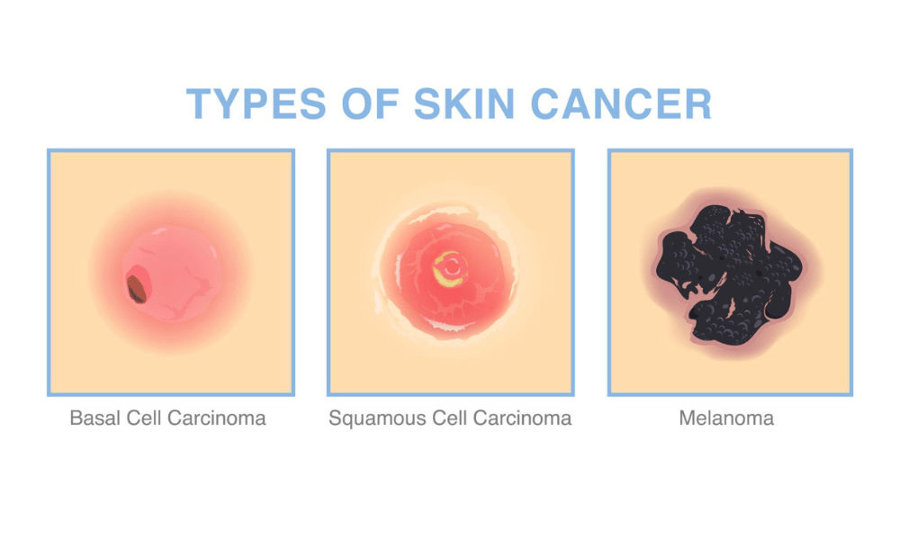 Complete Guide to Skin Cancer Checks in Belconnen (2026) 1